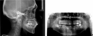 Radiografía lateral de cráneo y ortopantomografía finales.