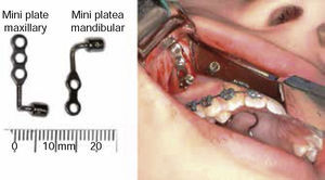 Modification of temporary anchorage devices (TADs). (Taken from: «Three-dimensional Analysis of Maxillary Protraction with Intermaxillary Elastics to Miniplates». Heymann, 2010).