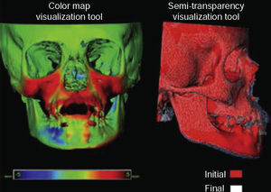 CBCT superimposition at T1 and T2. (Taken from: «Three-dimensional analysis of maxillary protraction with intermaxillary elastics to miniplates». Heymann, 2010).