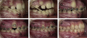A. Class III intermaxillary elastics; B. bite plane to achieve overjet; C-E. distalization mechanics; F. post-treatment. (Taken from: «Growth modification of the face: A current perspective with emphasis on class III treatment». De Clerk, 2015).