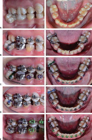 A) Initial photographs, B) 0.022” slot MBT appliance placement with modified lingual arch and lingual button on the buccal surface of the lower second molar activated through elastomeric chains and posterior bite turbos, C and D) elastomeric chain activation, E) 0.022” slot tube placement on the lower right second molar to continue its uprighting by means of orthodontic appliances.