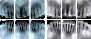 Initial and final periapical radiographic series.