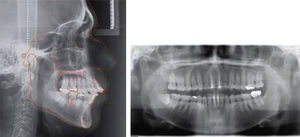 Initial lateral headfilm and panoramic radiograph.