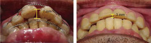 Overjet reduction, initial and final photographs. Observe the increase of the alveolar ridge in the upper incisor area.