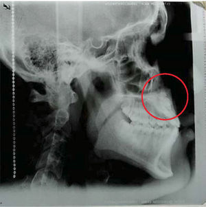 Radiografía lateral de cráneo pretratamiento.