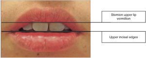 Localization of anatomical points for extraoral measurements.