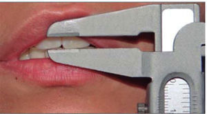 Measurement obtained with a caliper of several anatomical points for extraoral measurements.