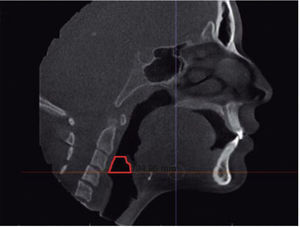 Sagittal slice, where the hypopharyngeal airway (HPA) was delimited to obtain the area.