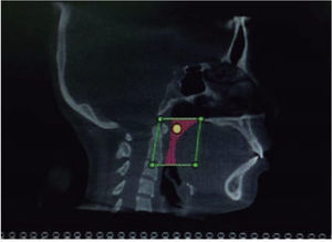 Sagittal view where the oropharyngeal airway was defined to obtain the volume.