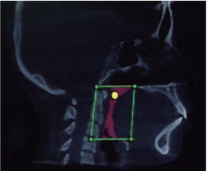 Sagittal view where the oropharyngeal airway and the hypopharyngeal airway was defined to obtain the total volume.