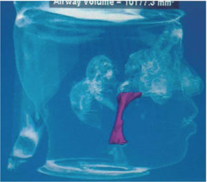 3D image obtained with the dolphin imaging program and management solution of the pharyngeal airway.
