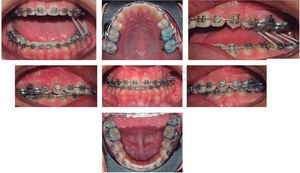 Post-surgical photographs with 0.019 × 0.025” stainless steel coaxial archwires 3/16”, 3.5 oz settling elastics and panoramic radiograph to assess root parallelism.