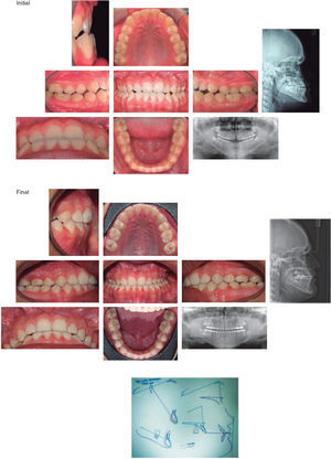 Comparative facial and intraoral photographs, initial and final panoramic radiographs, lateral headfilms and superimposition.