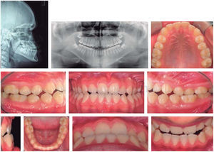 Initial radiographs and intraoral photographs.