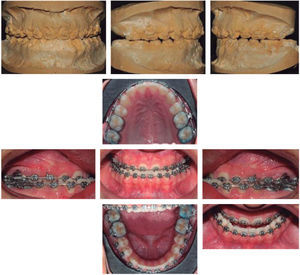 Class I canine relationship and control lateral headfilm to assess incisor inclination.