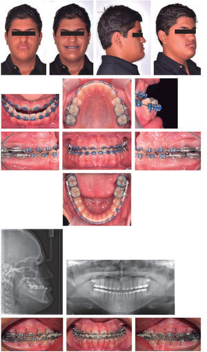 Control models for assessing the occlusion and intraoral photographs with 0.016” × 0.022” NiTi arch wires.