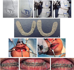 Pre-surgical records and 0.017” × 0.025” SS surgical arch wires.
