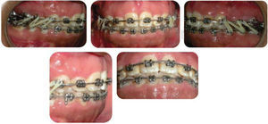 Intraoral photographs 19 months into treatment.
