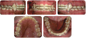 Intraoral photographs: circumferential retainers.