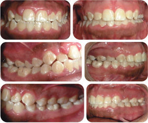 Initial and final intraoral photographs.