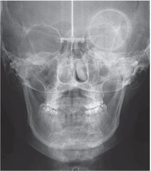 Initial posteroanterior radiograph where the mild maxillary collapse may be noted.