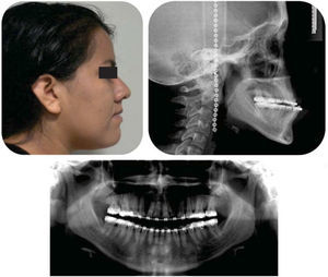 Presurgical facial profile photograph, lateral headfilm and panoramic radiograph.