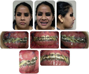 Facial photographs of the patient 7 days after the surgery.