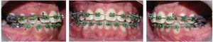 Treatment progress intraoral photographs. Remaining space closure and re-leveling in the lower arch.