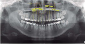Método de trazado. Ortopantomografía que muestra el método de trazado para obtener las inclinaciones mesiodistales de los ejes longitudinales de los órganos dentarios con respecto al eje infraorbitario.