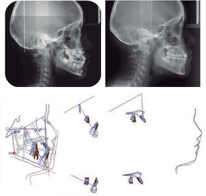 Comparación de las radiografías laterales de cráneo inicial y final, sobreimposición cefalométrica.