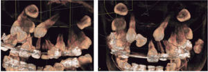 Tomografía Cone Beam (vista lateral izquierda, vista frontal).