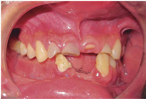 Foto intraoral lateral. Piezas dentales anterosuperiores fracturadas, ausencia de grupo incisivo inferior. Mordida cubierta posterior derecha.