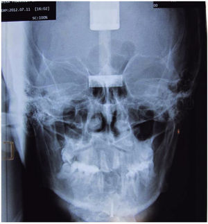 Radiografía posteroanterior. Se observa simetría con oclusión cubierta de lado derecho.