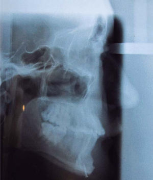 Radiografía cefálica. Relación maxilomandibular aceptable. Presencia de tornillo en sínfisis mandibular.