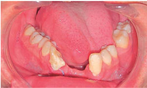 Foto intraoral arcada inferior. Arco en forma de «V», lado derecho intruido hacia la línea media.