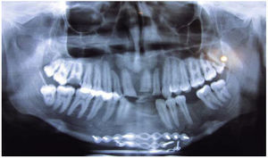 Radiografía panorámica inicial. Placas y tornillos a nivel de borde basal mandibular.