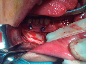 Fotografía transquirúrgica. Tornillos intermaxilares en sector posterior mandibular derecho, separación de nervio mentoniano con Penrose y corticotomía.