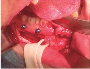 Fotografía transquirúrgica. Retiro de cortical, liberación del nervio mentoniano, y osteotomía a nivel de parasínfisis.
