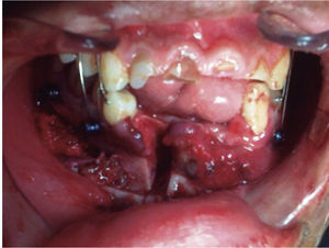 Fotografía transquirúrgica. Movilización del segmento alveolar en oclusión.