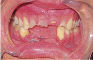 Fotografía intraoral. Oclusión posterior derecha estable.