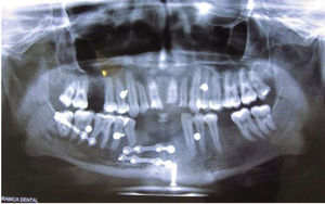 Radiografía panorámica postquirúrgica.