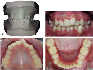 A. Study models. Frontal view. B. Intraoral frontal photograph. C Upper arch. D. Lower arch.