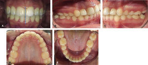 A. Frontal intraoral photograph. B. Right lateral photograph. C. Left lateral photograph. D. Upper occlusal photograph. E. Lower occlusal photograph.