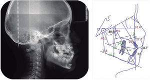 Lateral headfilm and cephalometry.