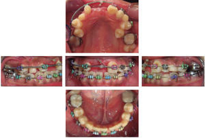 Intraoral photographs after the surgical placement of the lingual button in tooth #13.