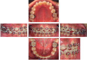 Intraoral photographs after the extraction of #73.