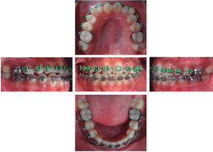Intraoral photographs where bracket placement in teeth #53 and 63 is shown.
