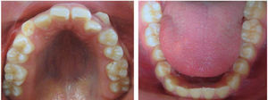 Initial intraoral photographs. Upper and lower arches.