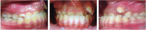 Intraoral photographs; frontal and right and left occlusion.