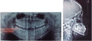 Initial radiographs. Orthopantomography and lateral headfilm.